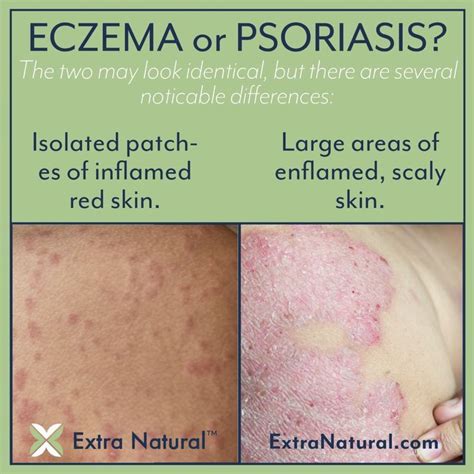 Eczema vs psoriasis are they one and the same – Artofit