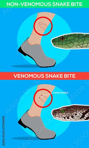 Venomous and non venomous snake bite in the leg. Snakebite. Beware of ...