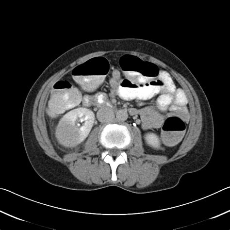 Renal pseudotumor | pacs