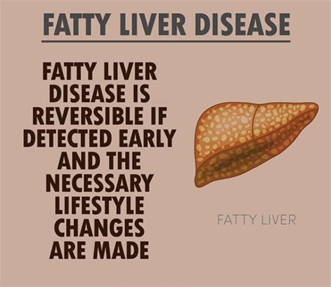 Mediterranean Diet : Non Alcoholic Fatty Liver Disease