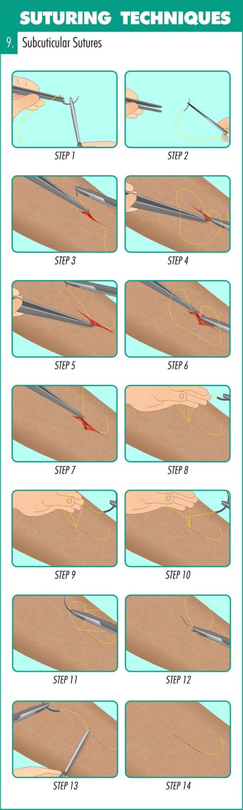 Complete Guide to Mastering Suturing Techniques | Suture techniques ...