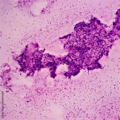 Thyroid nodule (FNA cytology): Cellular follicular lesion, microscopic show cellular material of ...