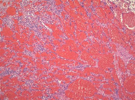 Histological variants of cutaneous Kaposi sarcoma | Diagnostic ...