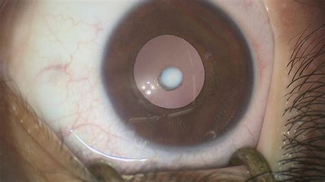 Types of congenital cataract - Gene Vision