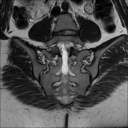 Normal sacroiliac joint (MRI) | Radiology Case | Radiopaedia.org