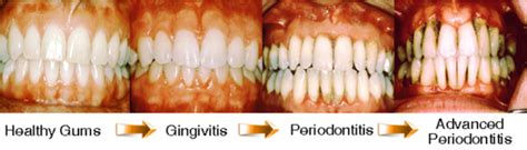 Periodontal Disease | Manchester, NH | Jason Sudati, DMD