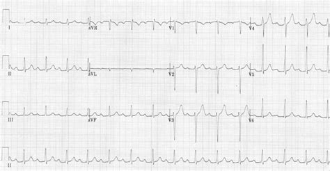 First Degree Heart Block • LITFL • ECG Library Diagnosis