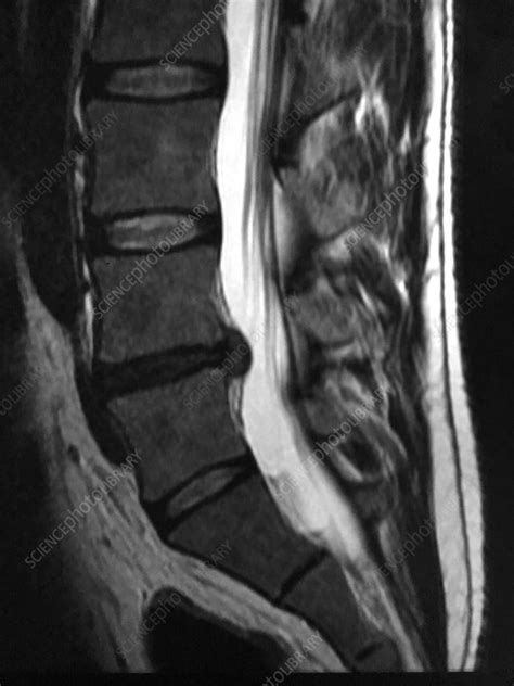 Lumbar Disc Herniation, MRI - Stock Image - C039/4164 - Science Photo Library