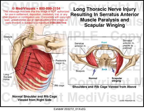 Long Thoracic Nerve Impingement