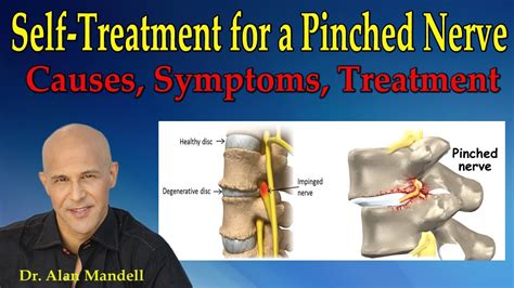 Self-Treatment for a Pinched Nerve (Causes, Symptoms, Treatment) - Dr Mandell - YouTube