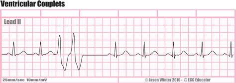 ECG Educator Blog : Ventricular Couplets