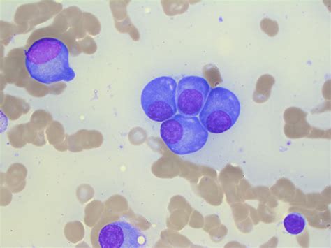 Plasma cell neoplasm | MyPathologyReport.ca