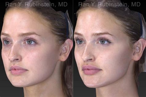 Chin Filler Before & After Photos | Newburgh, NY