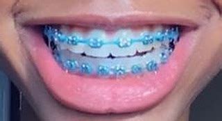 Light blue braces colors wheel - bdazero