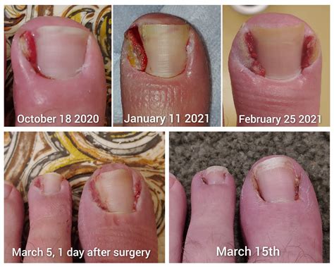 Progression and recovery after surgery : r/Ingrown_Toenails