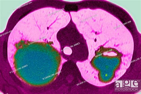 Granulomatosis with polyangiitis (systemic vasculitis - Wegener’s granulomatosis), Stock Photo ...