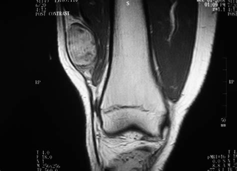 2C MRI Axial Synovial Sarcoma. Synovial sarcoma is a common soft tissue ...