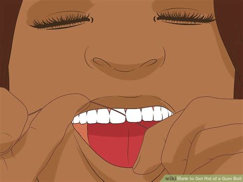 How to Get Rid of a Gum Boil: 10 Steps (with Pictures) - wikiHow