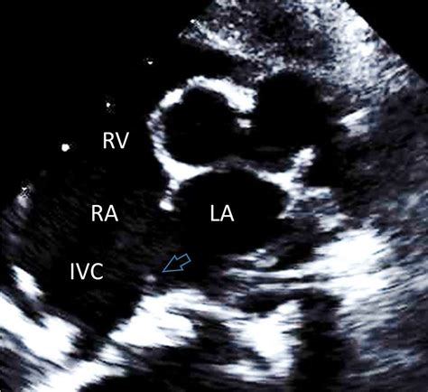 Parasternal Short Axis View Aortic Valve