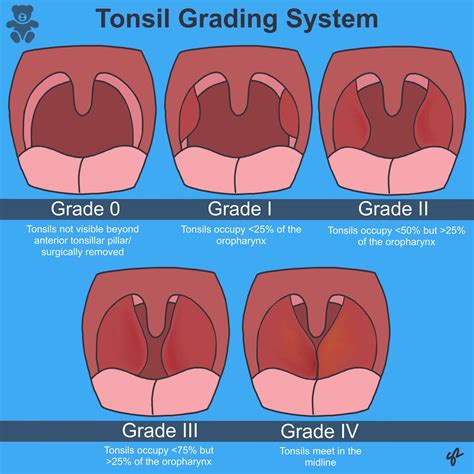 Bacterial Tonsillitis Vs Viral Tonsillitis