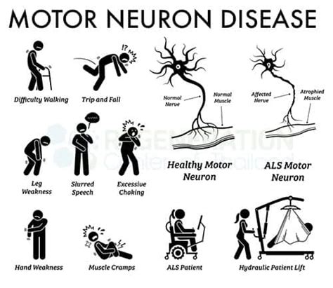 Stem Cell Treatment for Motor Neuron Disease MND