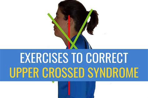 Exercises to correct Upper Crossed Syndrome | Sports Injury Physio