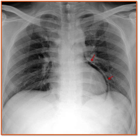 Pneumopericardium | Radiology imaging, Radiology, Diagnostic imaging