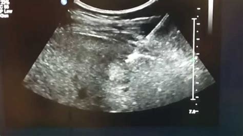 ULTRASOUND-GUIDED LIVER BIOPSY - YouTube