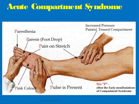 Compartment syndrome