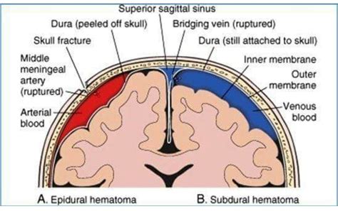 Epidural Vs Subdural Hematoma