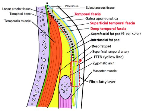 Schematic depiction of the anatomy of the temporal area in the coronal ...