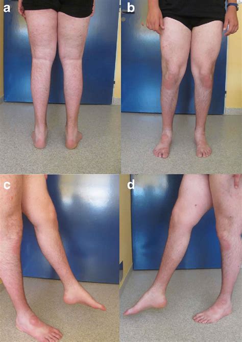 Neuromyotonia causes, symptoms, diagnosis, treatment & prognosis