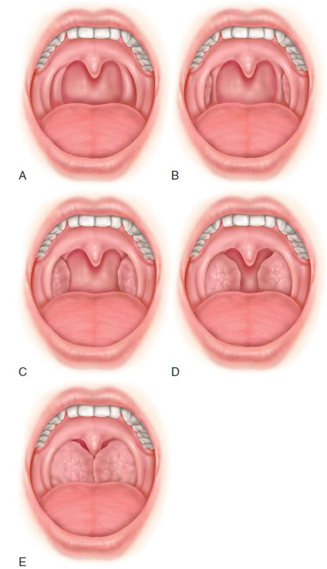 Tonsil Diagram Anatomy