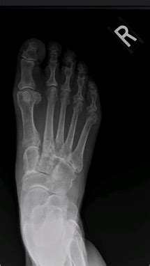 Midfoot Arthritis - Foot & Ankle - Orthobullets