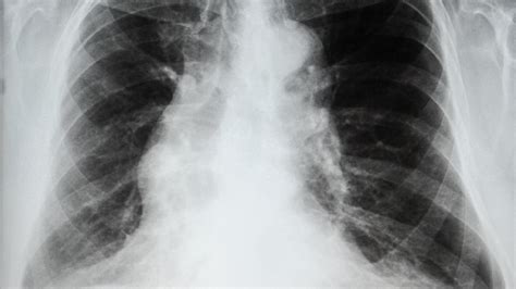 Emphysema Chest X Ray