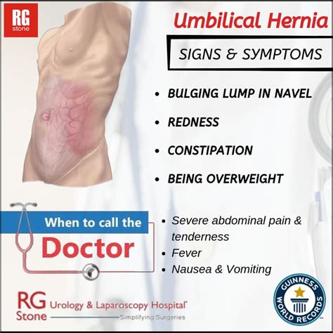 Umbilical Hernia | Umbilical hernia, Hernia repair, Hernia symptoms