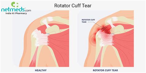 Rotator Cuff Tear: Causes, Symptoms And Treatment