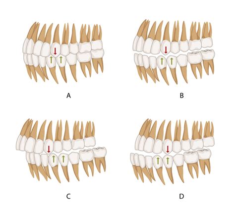 Dental Occlusion | Geeky Medics