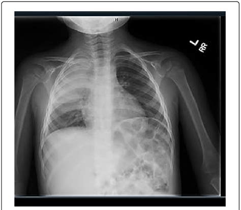 X-ray images showing large consolidation along with a small right... | Download Scientific Diagram