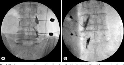 Figure 4 from Ultrasound-guided Lumbar Facet Nerve Blocks / 163 the ...