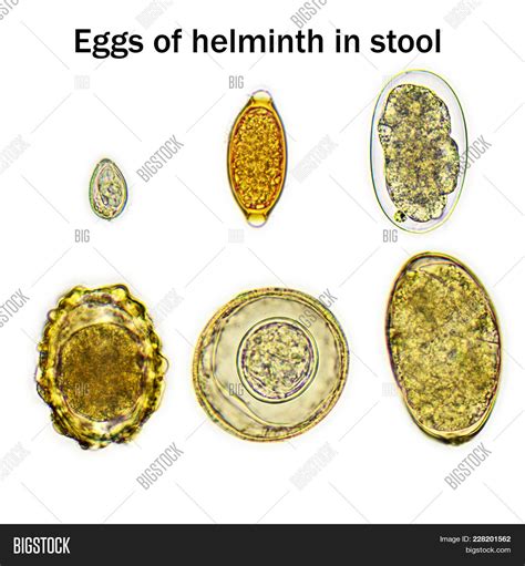 Mixed Helminths Stool Image & Photo (Free Trial) | Bigstock