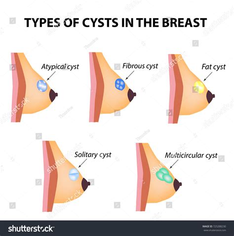 Types Cysts Breast Atypical Fibrous Fatty Stock Vector (Royalty Free ...