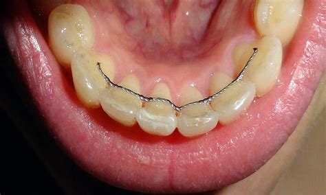 ORTHODONTIC fixed retainers. A systematic review - Directorio Odontológico