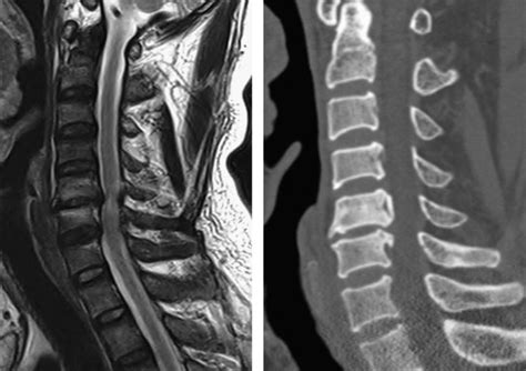 Spontaneous resolution of tetraparesis because of postoperative ...