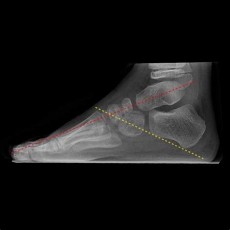 Lateral talocalcaneal angle | Radiology Reference Article | Radiopaedia.org Pes Planus, Ortho ...