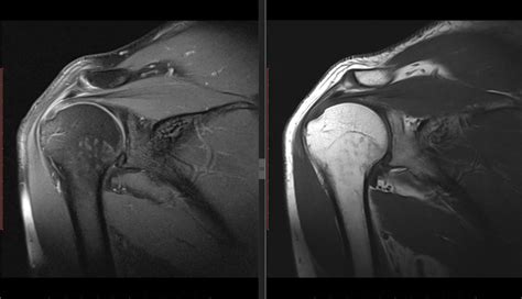 Shoulder Impingement - My Family Physio