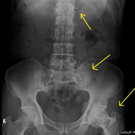 Paget's Disease of Bone - Sumer's Radiology Blog