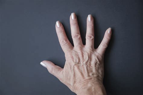 Can Low Salt Intake Improve Bulging Veins on Your Hands? | Healthfully