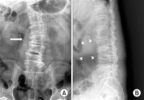 Degenerative Lumbar Spine X Ray