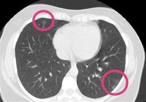 Scan Finds Coronavirus in Lungs of Healthy Woman with No Symptoms - Science news - Tasnim News ...